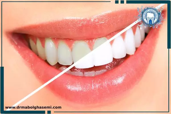 بلیچینگ دندان؛ راهی برای سفید کردن دندانها