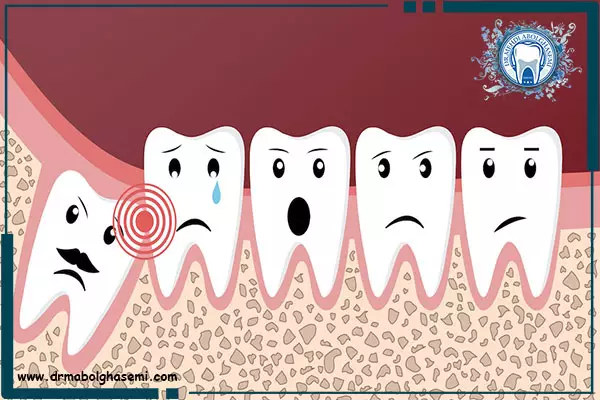 جراحی و کشیدن دندان عقل