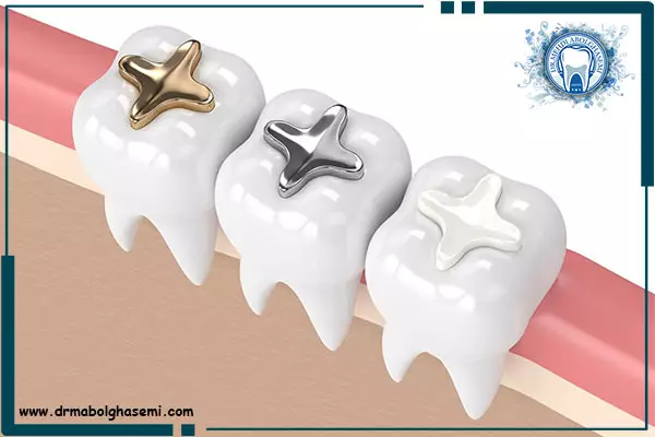 انواع روش های پر کردن و ترمیم دندان