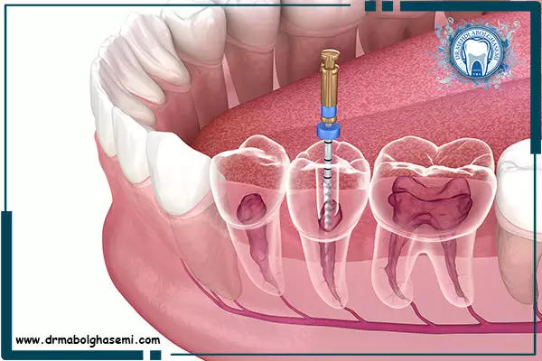 عصب کشی دندان