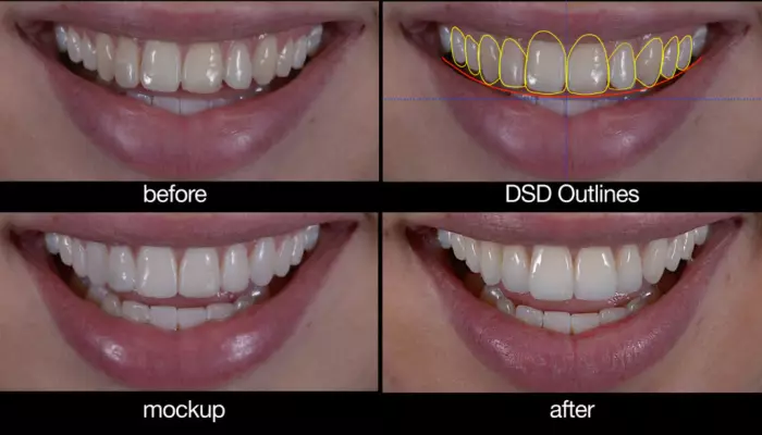 اصلاح طرح لبخند دیجیتال