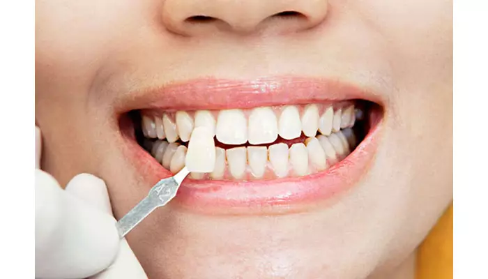 اصلاح-طرح-لبخند2