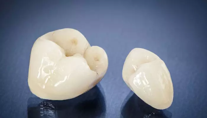 ترمیم-دندان-بدون-تاج1