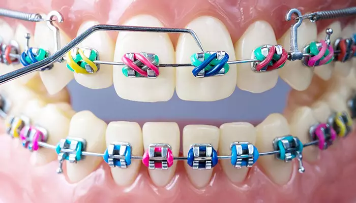 ارتودنسی از روش های اصلاح طرح لبخند