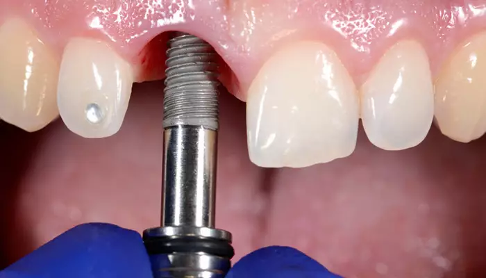 ایمپلنت در افراد دیابتی