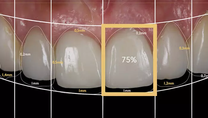 میزان ماندگاری اصلاح طرح لبخند چقدر است