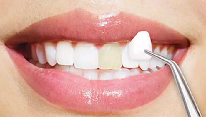 لمینت دندان چیست