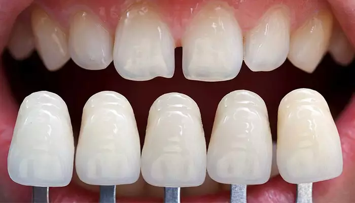 مزایا و معایب انواع لمینت دندان