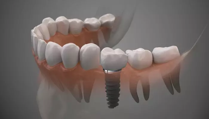 ایمپلنت دندان برای چه کسانی مناسب نیست